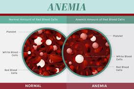 13 Ways To Heal Anemia Naturally Drjockers Com