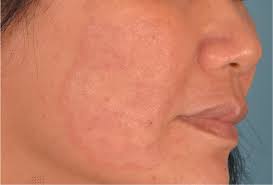 Image result for red rash face