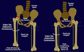 Image result for Functional Leg Length Discrepancy