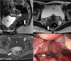 Endometriosis is more common in women who are having fertility issues, but it does not necessarily cause infertility. The Enzian Score As A Preoperative Mri Based Classification Instrument For Deep Infiltrating Endometriosis Semantic Scholar
