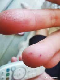手指上有红色出血点，破了后流血不止，有知道是什么病的么- 知乎