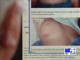Cancer is treated using different methods. Ibc Inflammatory Breast Cancer News Story Youtube