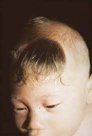 Image result for Hypertrichosis