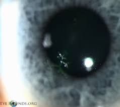 Hsv keratitis (hsvk) is the most common cause of corneal blindness in developed nations. Herpes Simplex Virus Hsv Epithelial Keratitis Dendrite Online Atlas Of Ophthalmology The University Of Iowa Ophthalmology