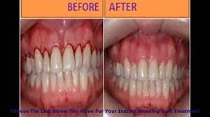 An obvious way to cure bleeding gums would be to stop the medication, but blood thinners are necessary for many people, since they are designed to prevent blood clots. Stop Bleeding Gums In In One Week Reliable Bleeding Gums Therapy Bad Breath And Bleeding Gums Youtube