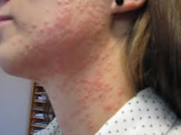 The rash consists of blisters that typically scab over in 7 to 10 days and clears up within 2 to 4 weeks. Nu Finns Vaccin Mot Baltros Som Forebygger Besvarliga Komplikationer