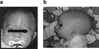 For this guide we included information about approximately 20 people with a 3p duplication. A Dysmorphic Boy With 4qter Deletion And 4q32 3 34 3 Duplication Clinical Cytogenetic And Molecular Findings Van Buggenhout 2004 American Journal Of Medical Genetics Part A Wiley Online Library