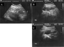 81 comments on his new pickup technique is unstoppable. Ultrasonographic Guided Percutaneous Transabdominal Puncture For Oocyte Retrieval In A Rare Patient With Rokitansky Syndrome In An In Vitro Fertilization Surrogacy Program Fertility And Sterility