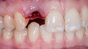 My Tooth Is Knocked Out What Should I Do Now