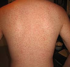 There is no treatment for mono, but supportive care involves resting and drinking plenty of fluids. Infectious Mononucleosis Wikipedia