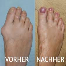 Falls es durch konservative therapiemaßnahmen also nicht zur. Hallux Valgus Op Minimalinvasiv Dr Michael Vitek 1120 Wien