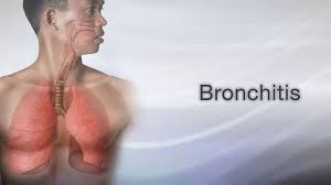 Image result for Acute Bronchitis