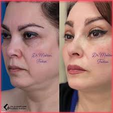 لبنات درت راديوفريكونس فراكسيوني وبقاو اتار الإبر في وجهي دازو ربعة ديال  سيمانات و مزا الاتار ما مشاوش ما تعرضت لا للشمس لا والو واش عادي عفاكم لي  دازت من هاد التجربة