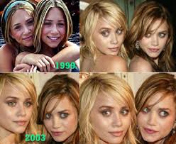 Olsen Twins Plastic Surgery Before And After Result Of Growing