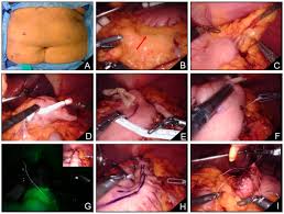 This guide will help you get ready for your esophagectomy surgery at memorial sloan kettering (msk). Robotic Esophagectomy How I Do It