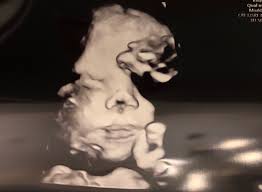 Does My Baby Look Like He Has Down Syndrome July 2019 Babies Forums What To Expect