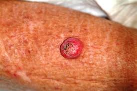 Skin cancer is the most common type of cancer in the united states by a pretty large margin, and it does not discriminate. Lesion Has Doubled In Size In Two Weeks Clinician Reviews