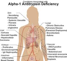 Alpha 1 Antitrypsin Deficiency Wikipedia