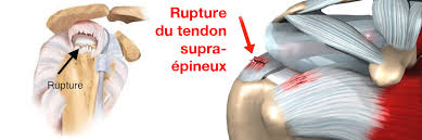 The peroneal tendons are in the feet and provide balance and stability during movement. Rupture De La Coiffe Des Rotateurs Le Site De L Epaule