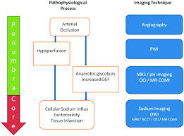 Image result for Stroke Pathophysiology