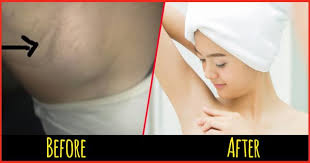 13 Home Remedies To Reduce Armpit Lumps