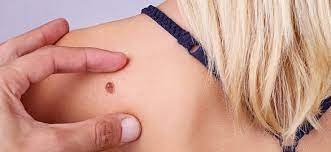 From 1982 to 2011 rates of melanoma in the u.s. Malignes Melanom Gefahrlicher Hautkrebs Medizinfuchs De