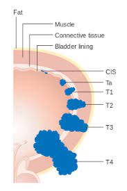 Although the percentage of cases in men is much lower than in women, male breast cancer accounts for a por. Tnm Staging System Wikipedia