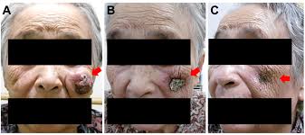 Diagnosis requires microscopic evaluation as the clinical appearance is nonspecific and can mimic a variety of benign and malignant skin lesions. Cureus Definitive Radiation Therapy For Merkel Cell Carcinoma Misdiagnosed As A Metastatic Tumor A Case Report