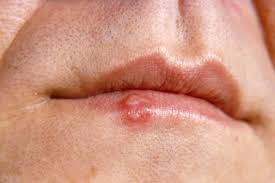 Vesicles may also develop on the lips and skin around the mouth (herpetic dermatitis), and cervical lymphadenopathy can occur. Cold Sores Nhs