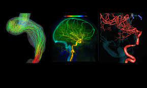 What Is Pulsatile Tinnitus