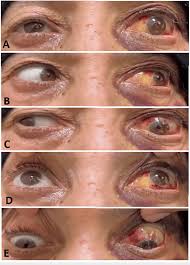 Image result for Lateral Canthotomy