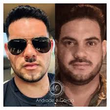 Com um nome no mínimo diferente, a bichectomia é um procedimento que ficou popularentre aqueles que desejam uma aparência mais bonita. Consultorio Odontologico Andrade Garcia Bichectomia Publicaciones Facebook