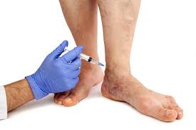 Managing Chronic Venous Insufficiency Venous Insufficiency Chronic Venous Insufficiency Treatment Vascular Insufficiency