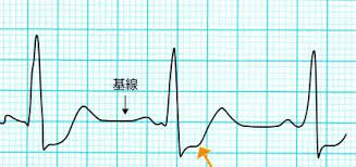 Feb 22, 2020 · 図1 avrtとavnrtの心電図波形 wpw症候群. Https Royal Mck Or Jp Images Researchpdf Researchpdf B0kn7wqedsk14t94fhhv1ajwzaifs4mj 4 Pdf