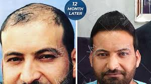 Before After 12 Month Later 12 Ay Sonraki Hali Sac