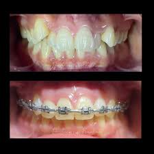 Image result for Multidentia exserta