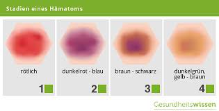 Hamatom Ursachen Risikofaktoren Hilfe Bei Blauen Flecken