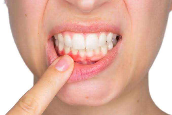 Tratamiento Periodontal