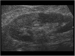 There are numerous etiologies of renal disease/renal failure. Urinary Tract And Male Reproductive System 2 1 Kidney And Ureter Case 2 1 14 Renal Vascular Disease Ultrasound Cases
