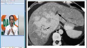 Radiology Spotters 28 Budd Chiari Syndrome Ct By Dr Sumer Sethi Youtube