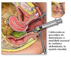 Extrauterine complicaia cea mai periculoas a sarcinii extrauterine este hemoragia intern puternic, care poate conduce la moartea femeii gravide n timp de cteva zeci de minute sau n cteva ore. Poze Medicale Sarcina Ectopica Extrauterina