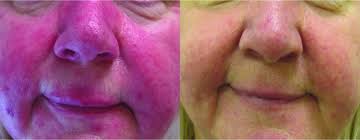 These treatments improve disease course and quality of life. The Revive Light Therapy Era How Led Devices Work Heliotherapy Research Institute