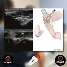 Image result for Elbow Joint Injection