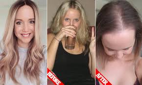 Try and avoid or control your alcohol consumption as much as stress is also one of the popular reasons for poor facial hair growth. Woman 33 Reveals How She Lost 70 Per Cent Of Her Hair After Switching Contraceptive Pill Daily Mail Online