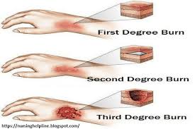 Different Types Of Burns Burns Treatment Burn Remedy 2nd Degree Burns Treatment