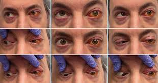 Image result for Diplopia