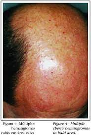 Largely harmless, a cherry angioma is a cluster of burst skin vessels that can appear anywhere on the body. Cherry Hemangioma In The Scalp