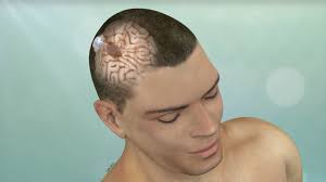 This can prevent strokes, bleeding, and brain damage. Minimally Invasive Brain Surgery Keyhole Craniotomy Pacific Brain Tumor Center