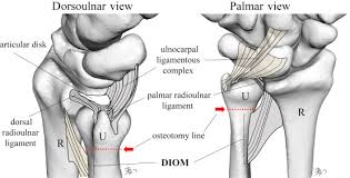 The proximal radioulnar joint is located near the elbow, and is an articulation between the head of the. Impact Of Distal Ulnar Fracture Malunion On Distal Radioulnar Joint Instability A Biomechanical Study Of The Distal Interosseous Membrane Using A Cadaver Model Journal Of Hand Surgery