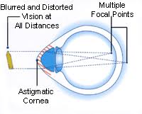 Feb 10, 2017 · focal twitching of the hands or face, nystagmus, eye blinking, or chewing movements. Home Page Eye Contact Vision Center
